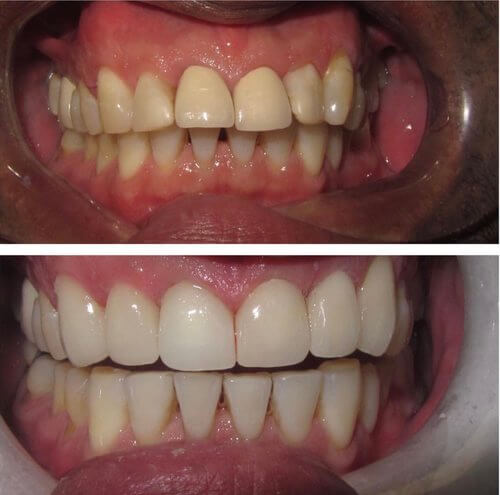 Before and after teeth whitening