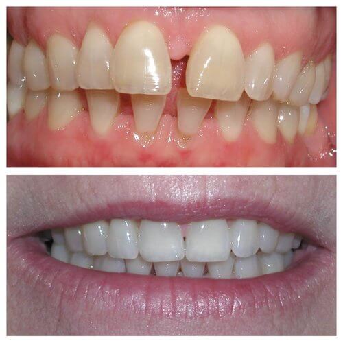 Before and after Invisalign®