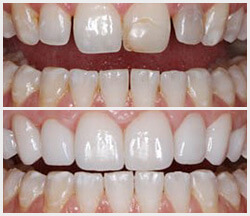 Before and after treatment