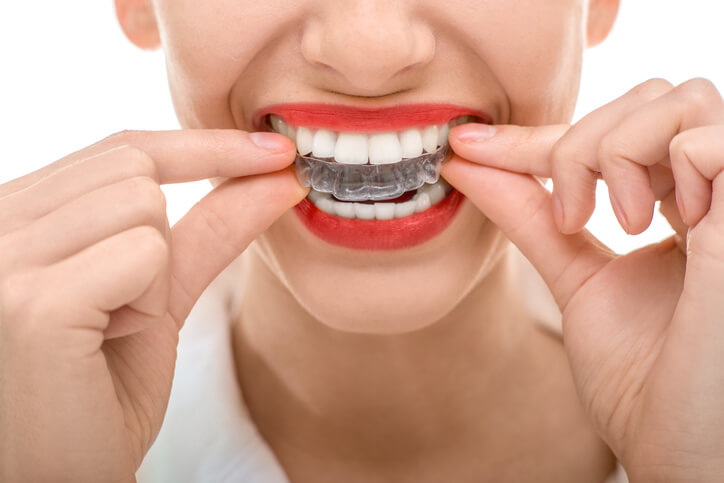 Invisalign clear aligners