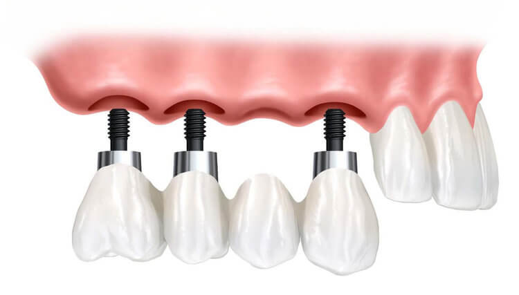 Implant-Supported Dental Bridge