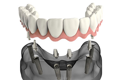 implant-supported dentures treatment