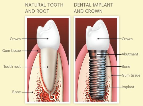 Illustration comparing a natural tooth and root with a dental implant and crown, highlighting components like crown, gum tissue, tooth root, bone, abutment, and implant relevant to bone grafting for dental implants.