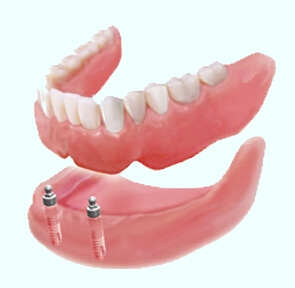 Implant-Supported Dentures