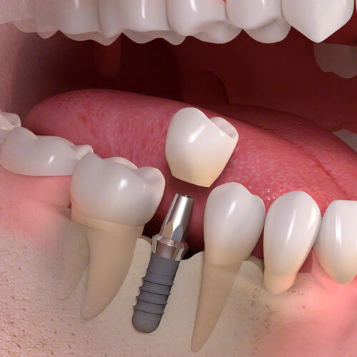 Digital Model of Implant treatment