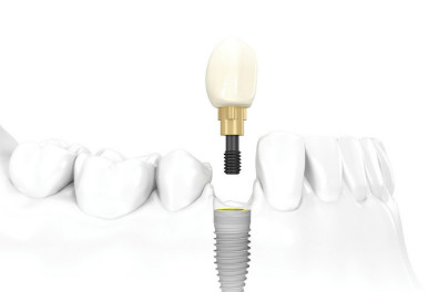 how an endosteal dental implant works