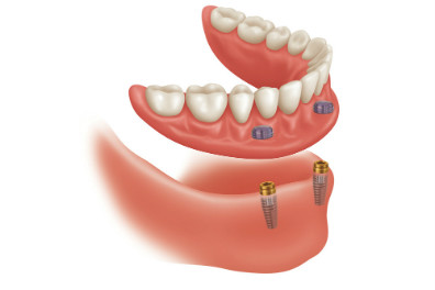 implant-supported dentures