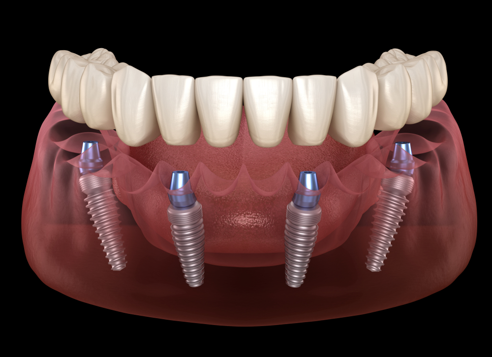 All-on-4 dental implants