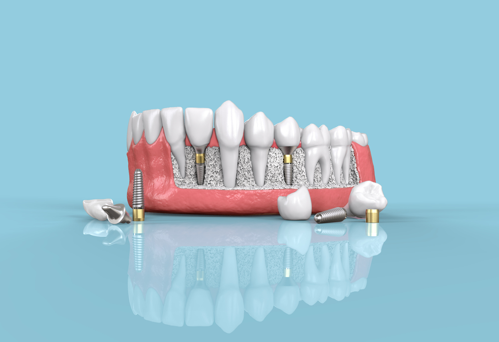 Debunking Common Dental Implant Myths