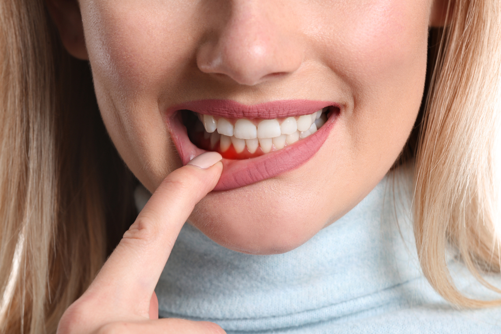 bleeding in the gums caused by gum disease