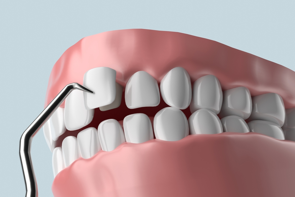 veneers placed over the natural teeth
