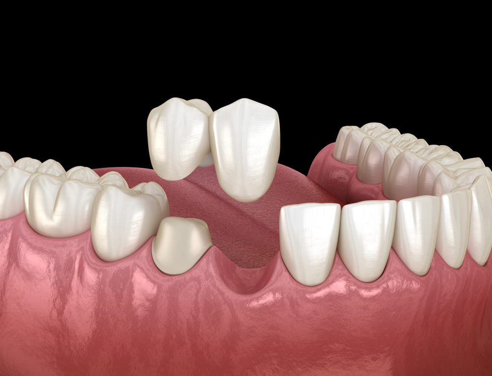 cantilever dental bridges
