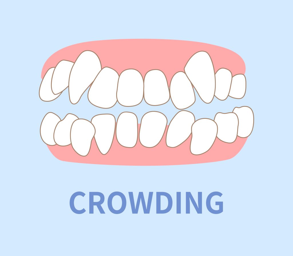 tooth crowding