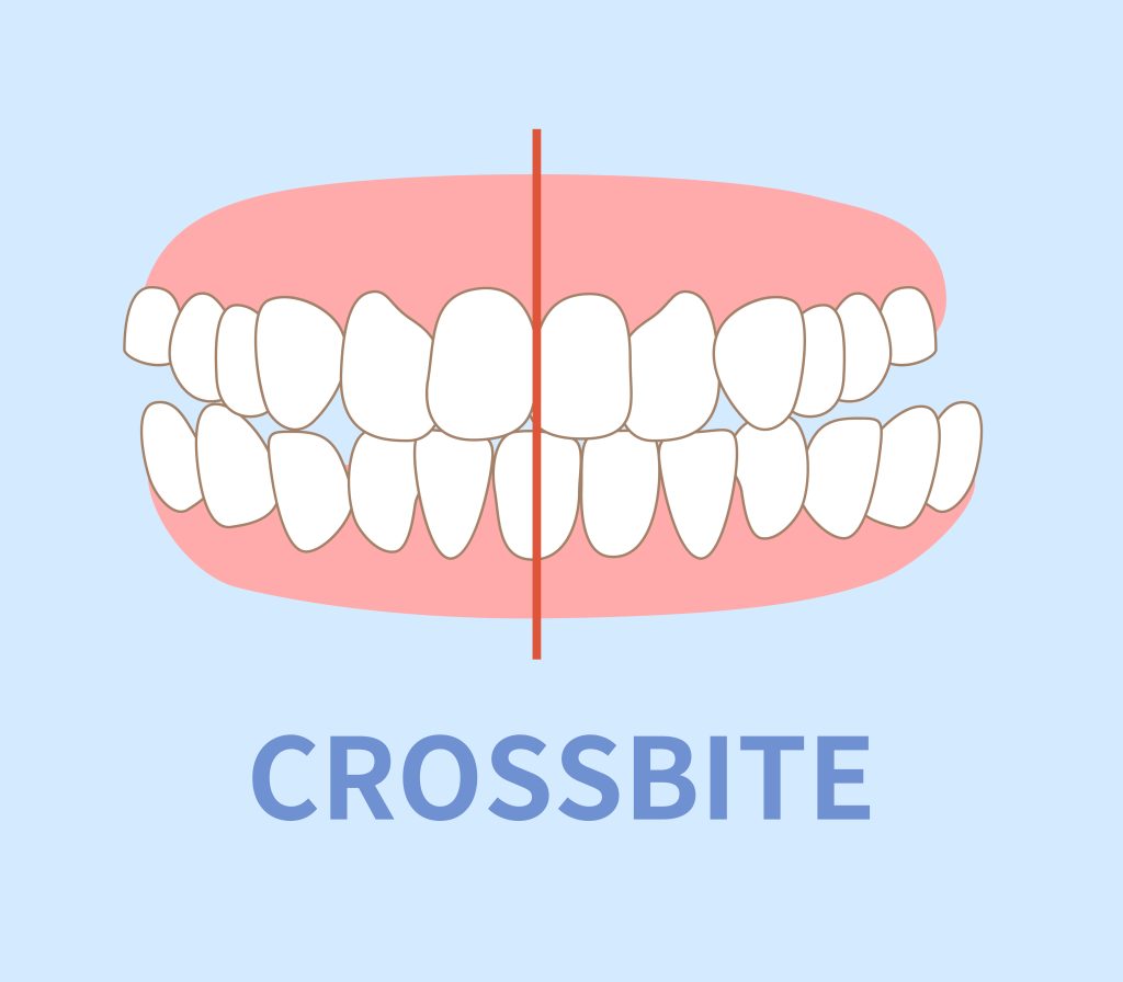 crossbites