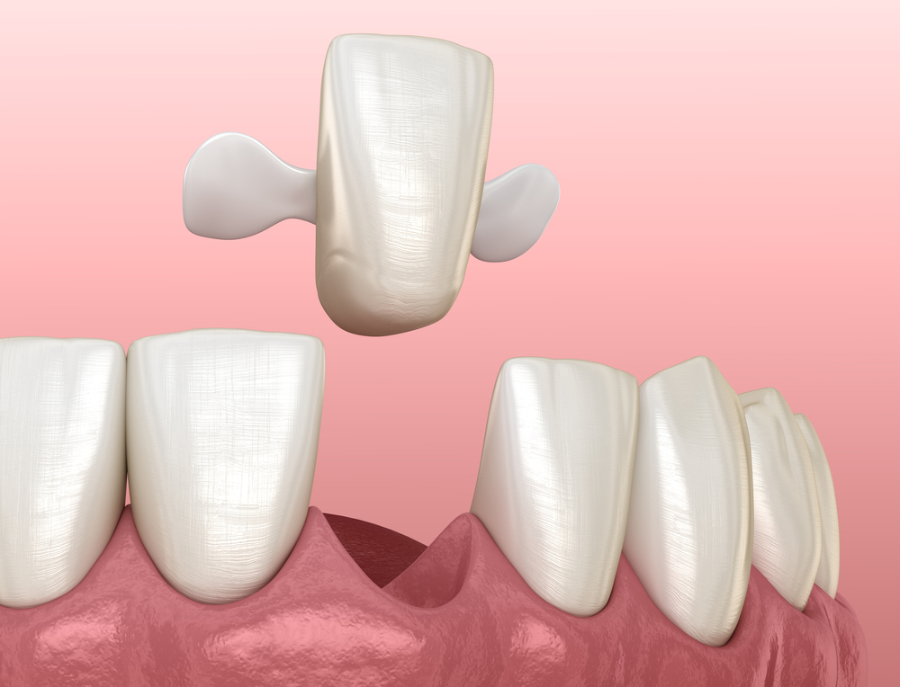 Maryland dental bridge