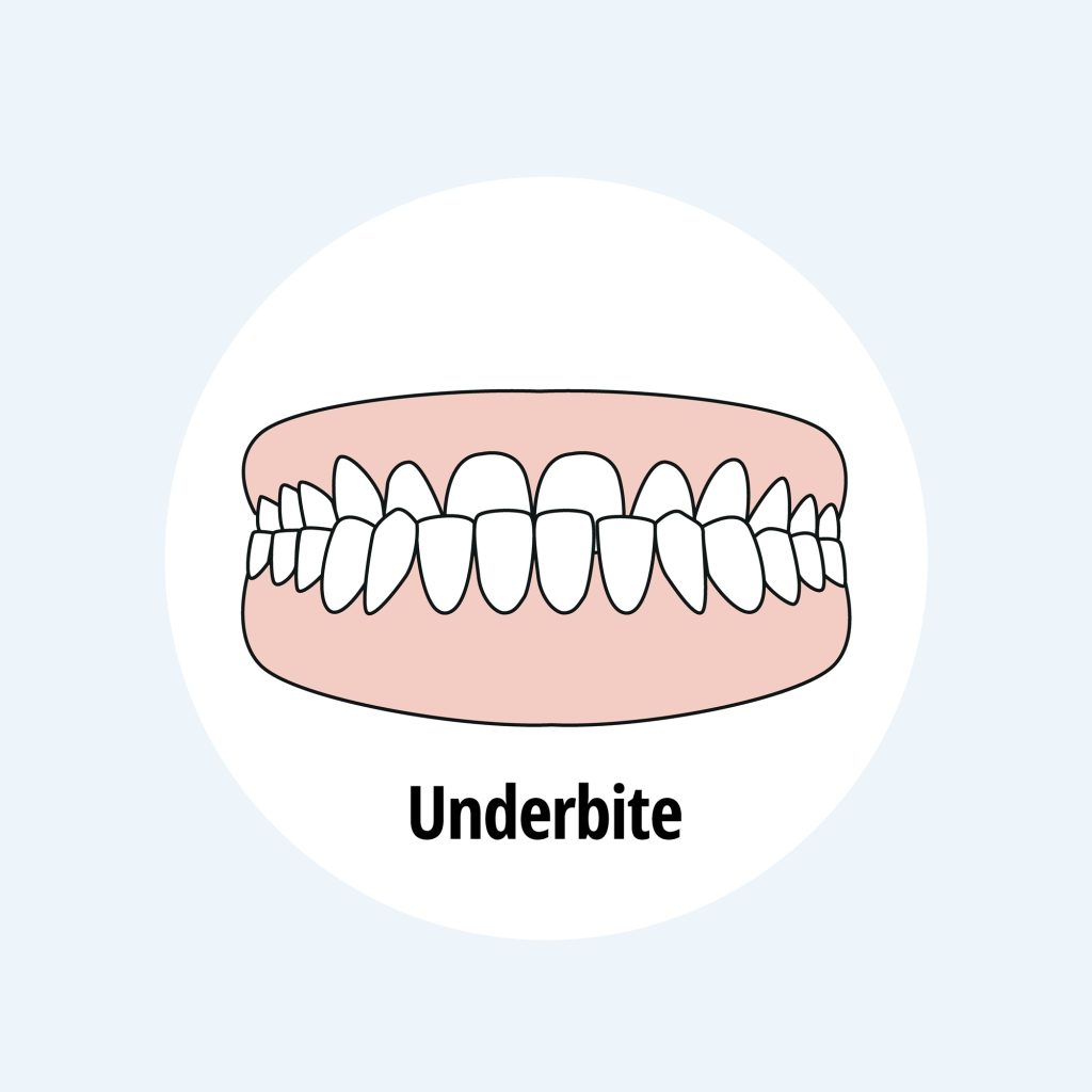 underbites