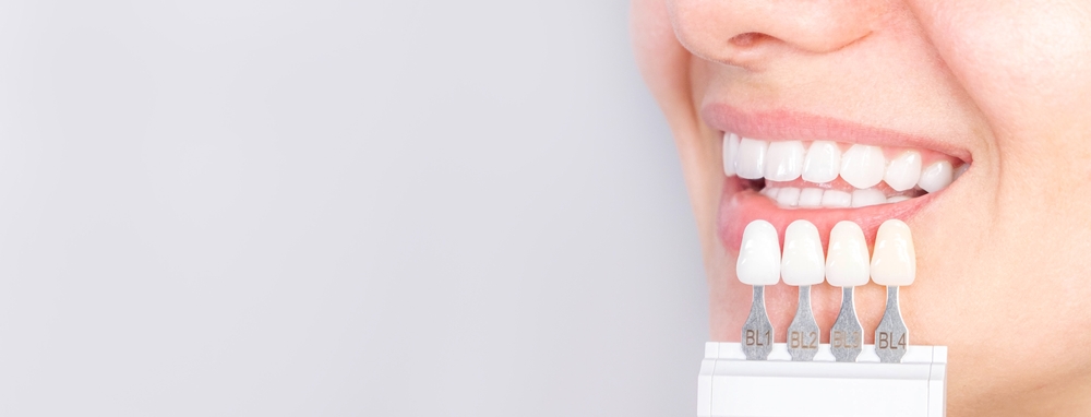 The Different Types of Dental Veneers