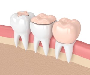 dental crowns and inlays and onlays