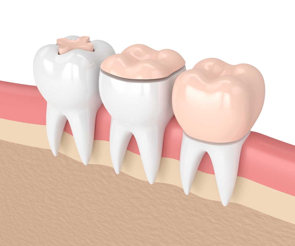 dental crowns and inlays and onlays