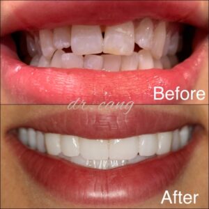 before and after cosmetic dental treatment in Staten Island